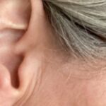 Tinnitus