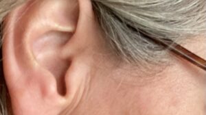 Tinnitus